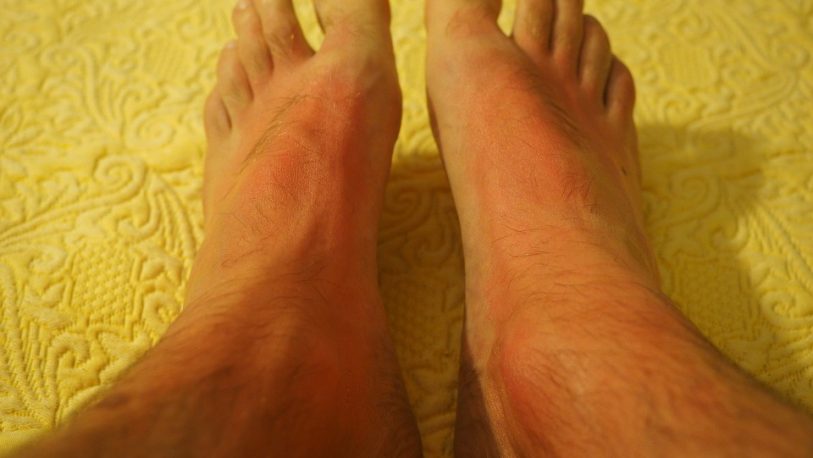 Consejos para evitar la hinchazón de pies o piernas en verano