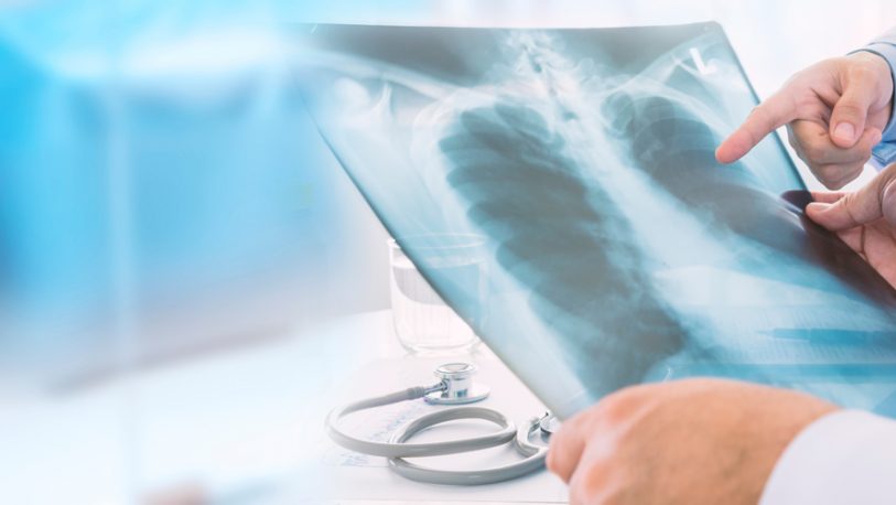 Cáncer de pulmón: recuerdan la importancia de la detección temprana
