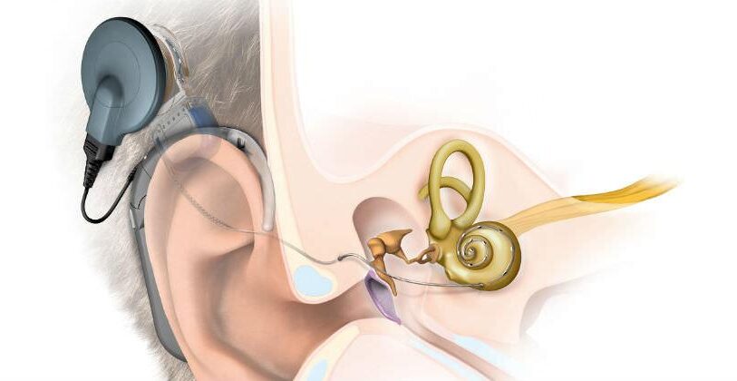 Harán el primer implante auditivo Bonebrigde en Misiones