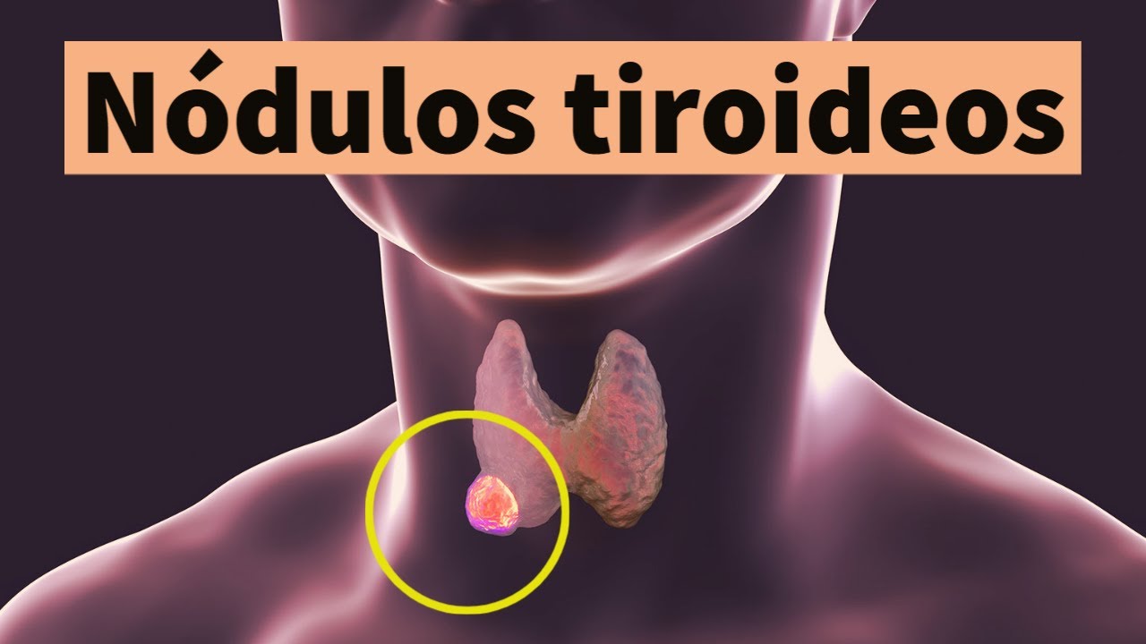 Alimentacion tiroiditis de hashimoto