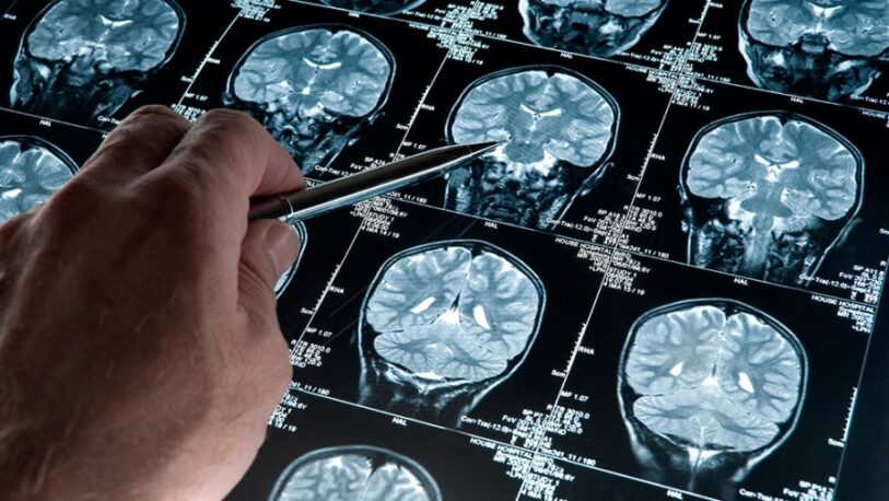 Argentinos desarrollaron un software para diagnosticar de forma precoz el Alzheimer