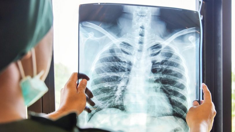 Cáncer de pulmón: presentaron en el país un nuevo tratamiento de alta eficacia